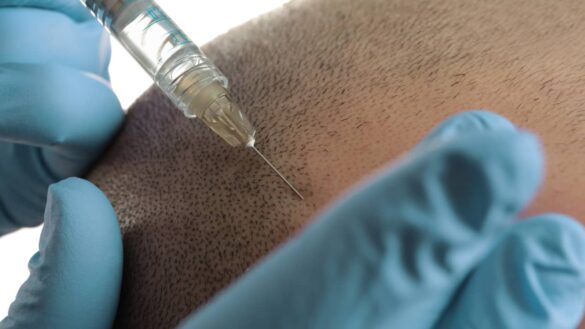 technique de greffe de cheveux soft fue