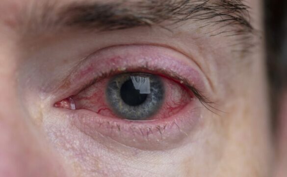 Pourquoi yeux rouges drogue ?